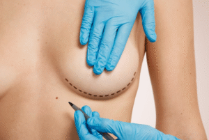 Breast Augmentation